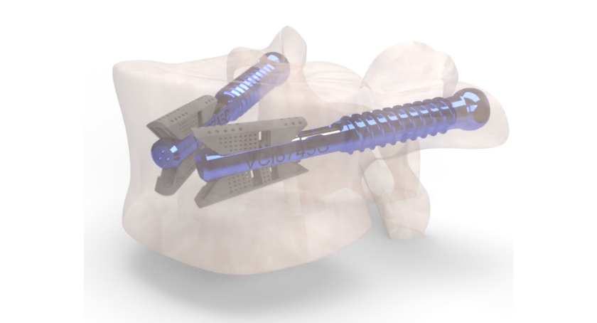 Amber Implants Wins FDA Nod for VCFix Spinal System